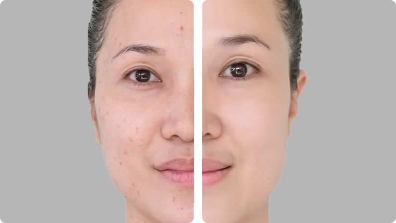 Accutane before result