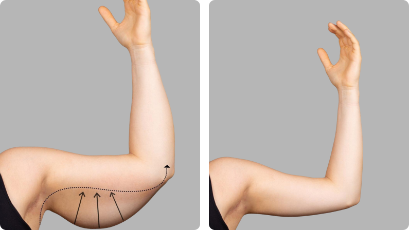 Arm Lift before result