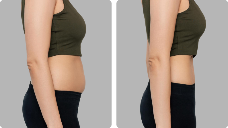 Body Lift before result