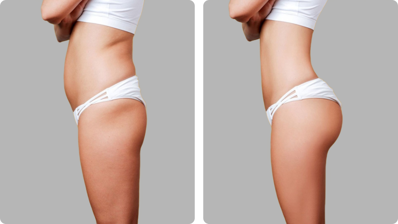 BBL (Brazilian Butt Lift) before result