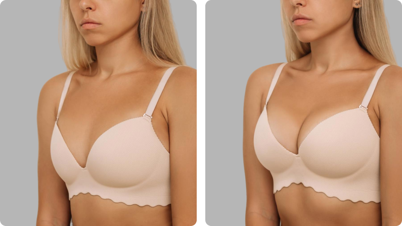 Breast Augmentation before result