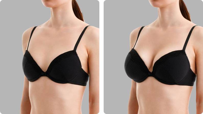 Breast Implants before result