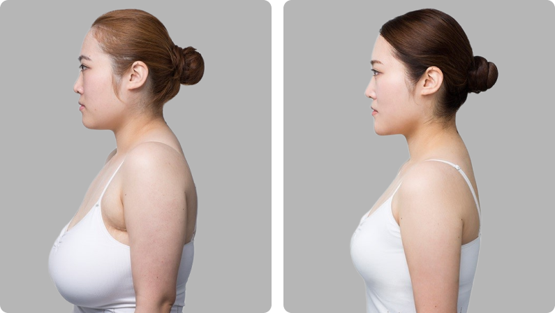 Breast Reduction before result