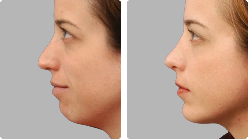 Chin Implant before result