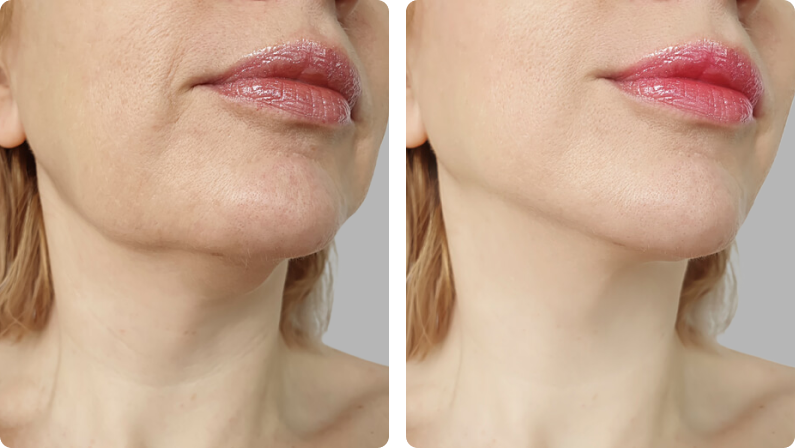 Chin Liposuction before result