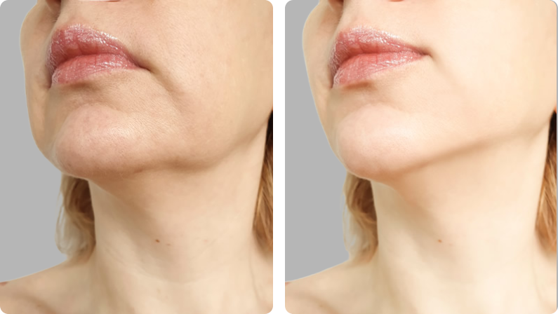 CO2 laser before result