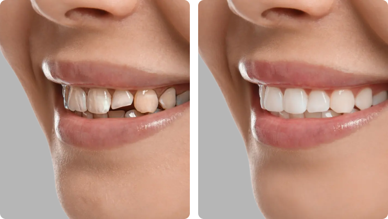 Dental Bonding before result