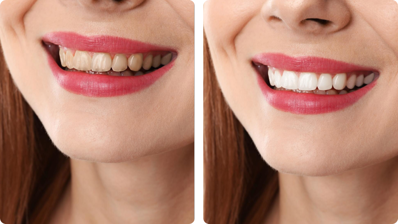 Dental Crowns before result