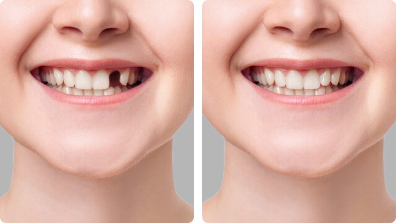 Dental Implants before result