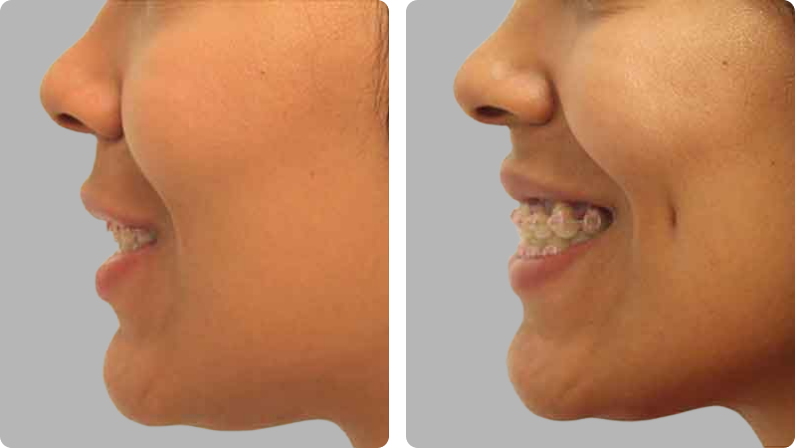 Dimple Creation before result