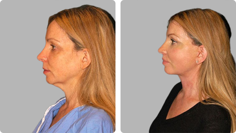 Face Lift before result