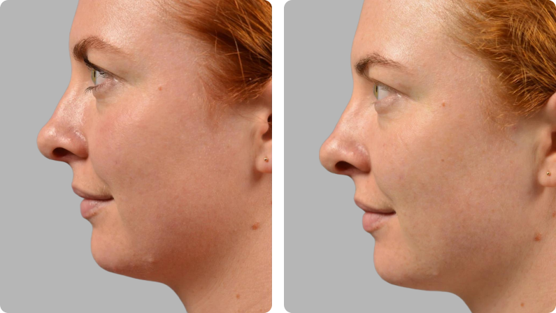 Halo Laser before result