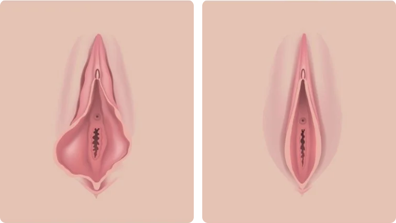 Labiaplasty before result