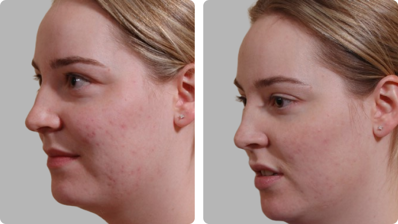 Laser Skin Resurfacing before result