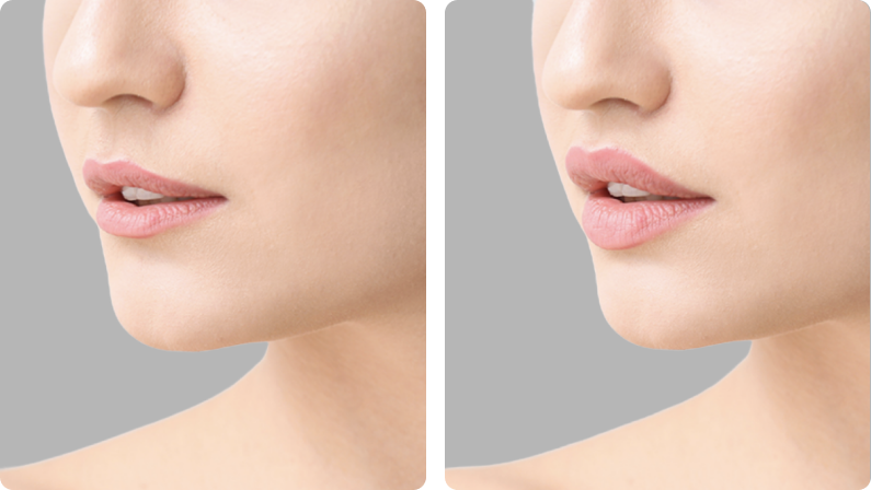 Lip Fillers before result