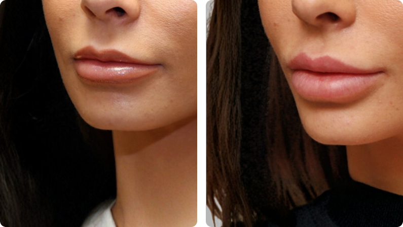 Lip Implant before result