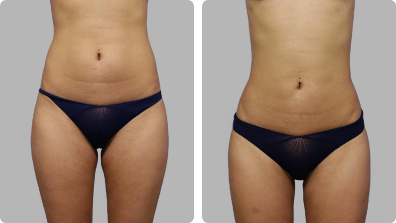 Liposuction before result
