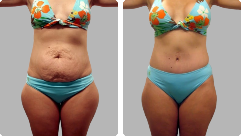 Mommy Makeover before result