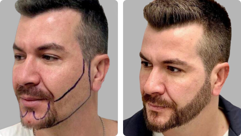 Moustache and Beard Transplant before result