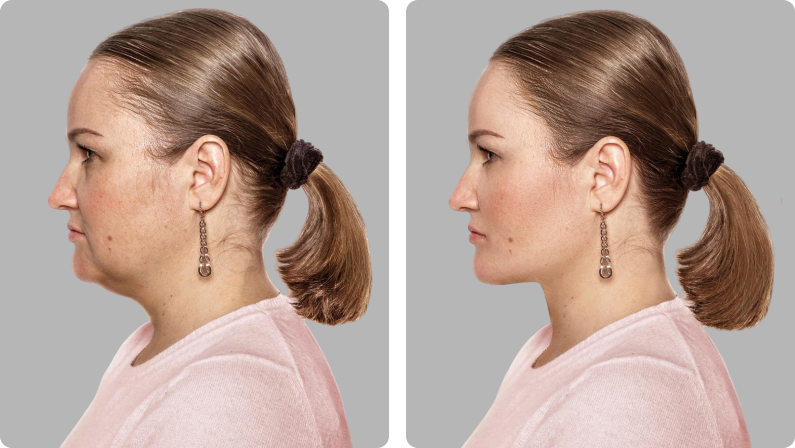 Neck Lift before result