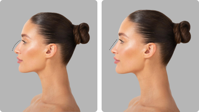 Nose Surgery Rhinoplasty before result