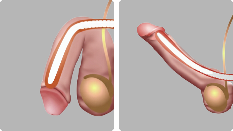Penile Augmentation before result
