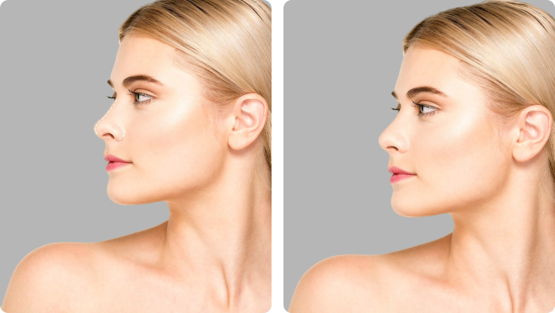 Septoplasty before result