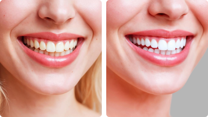 Teeth Whitening before result