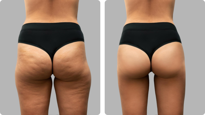 Thigh Lift before result