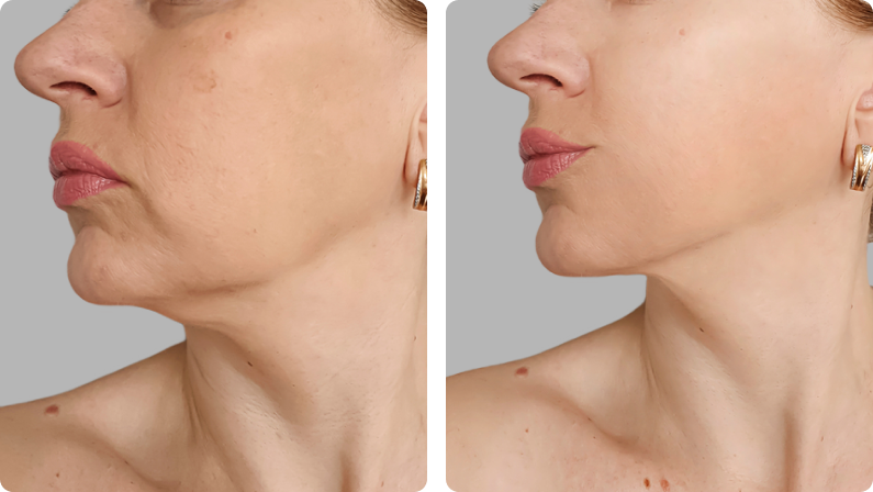 Thread Lift before result