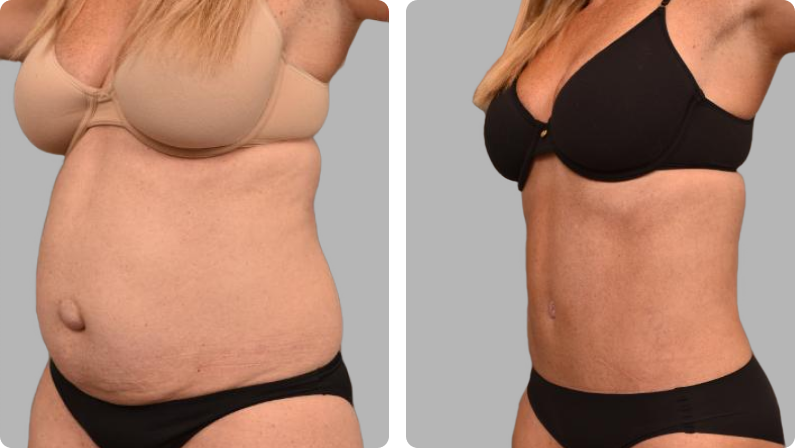 Tummy Tuck Surgery before result