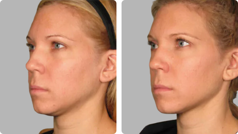 Ultherapy before result