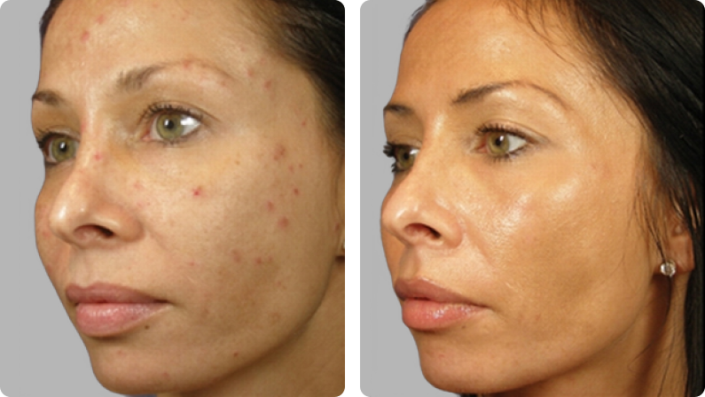 VI Peel before result