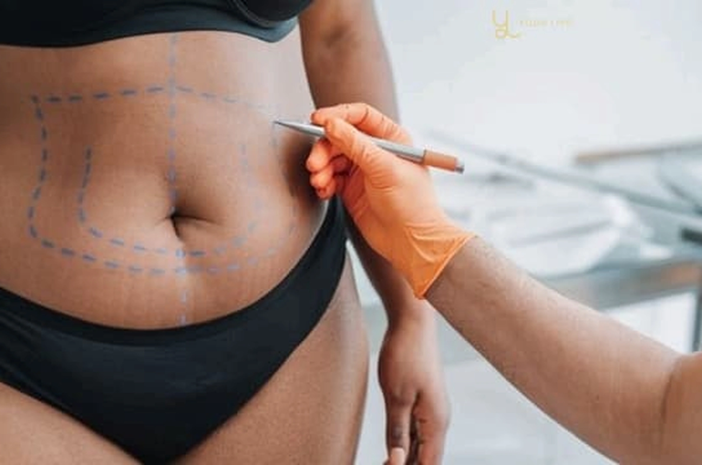 Liposuction