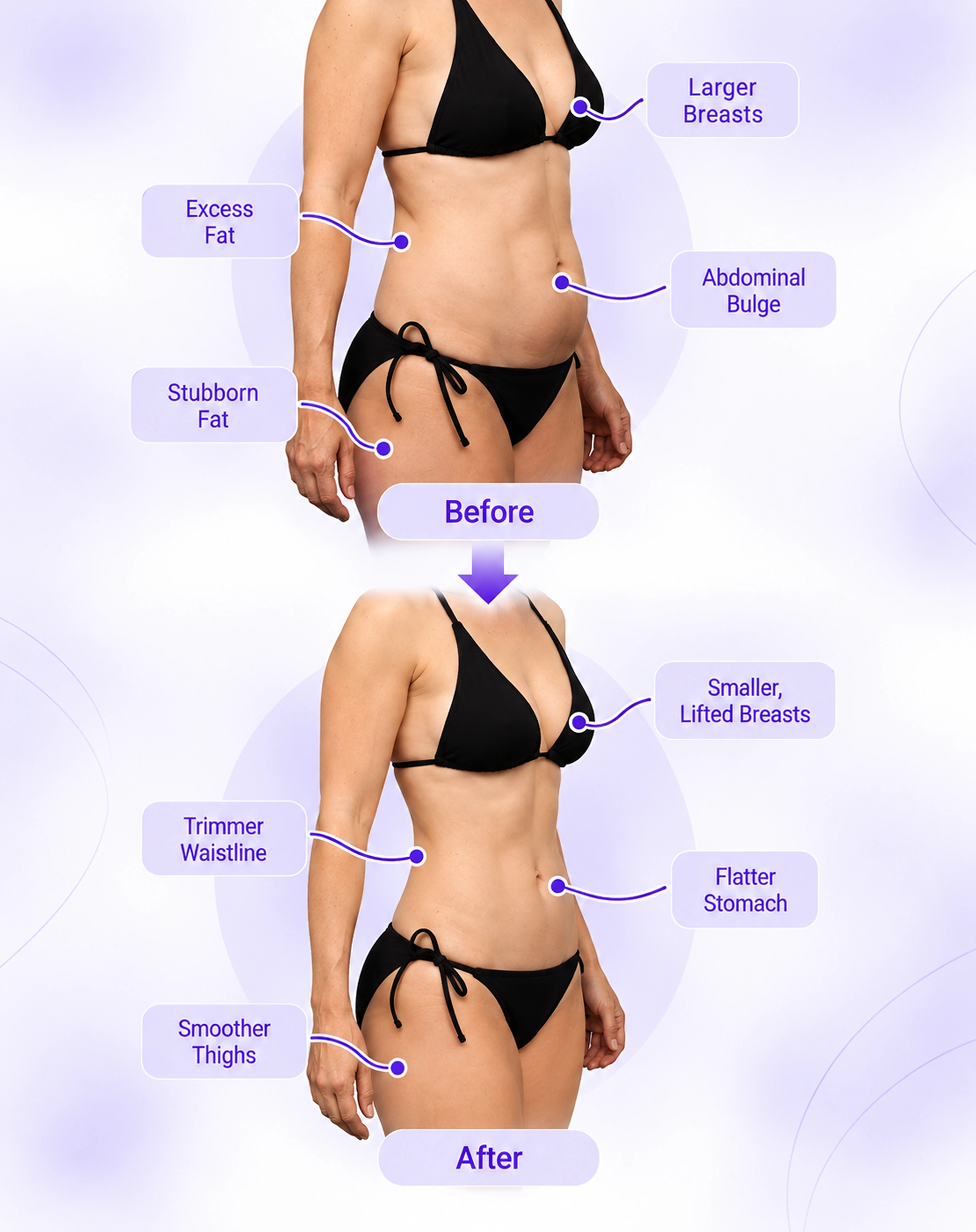 Mommy Makeover Before And After