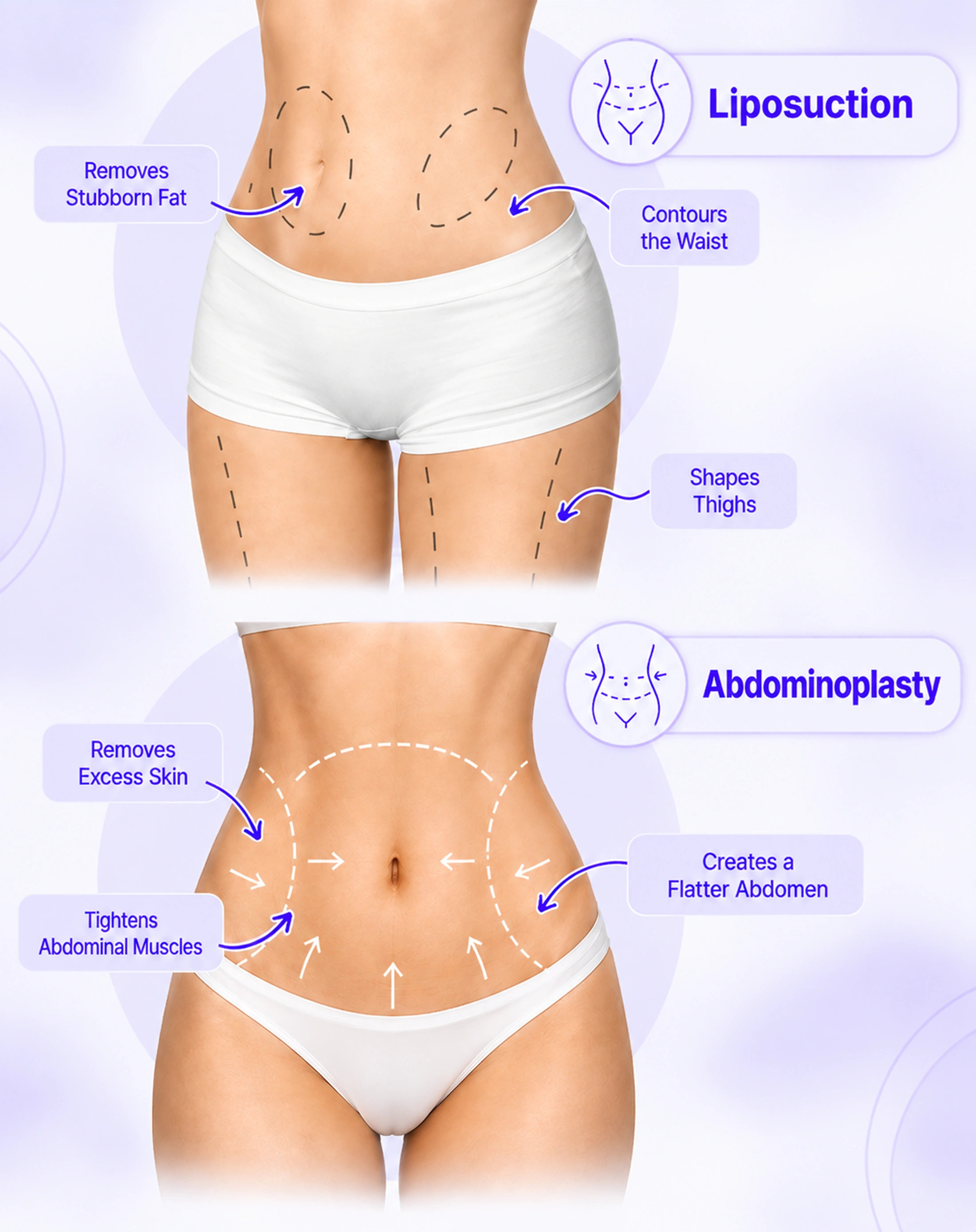 Tummy Tuck vs Liposuction