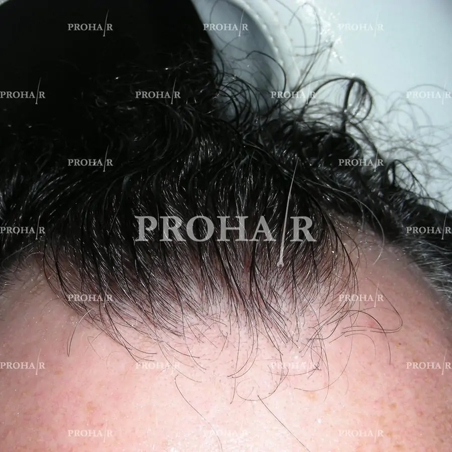 Prohair Transplant Clinic Budapest - Image 2