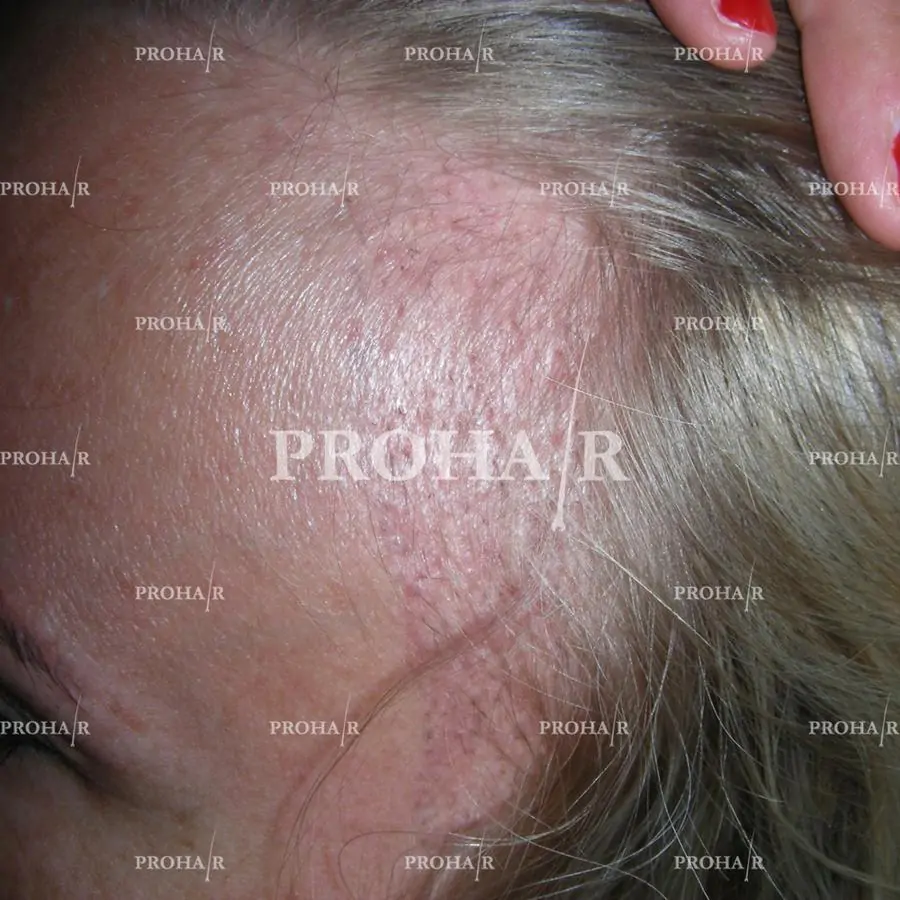 Prohair Transplant Clinic Budapest - Image 3