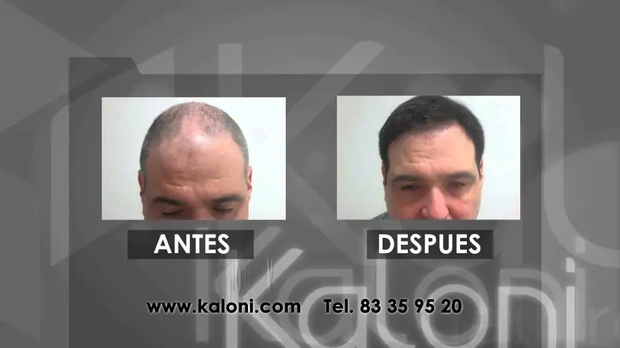 Kaloni Monterrey - Image 2