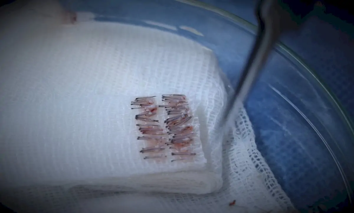 Emphair Hair Transplant Clinic - Image 2