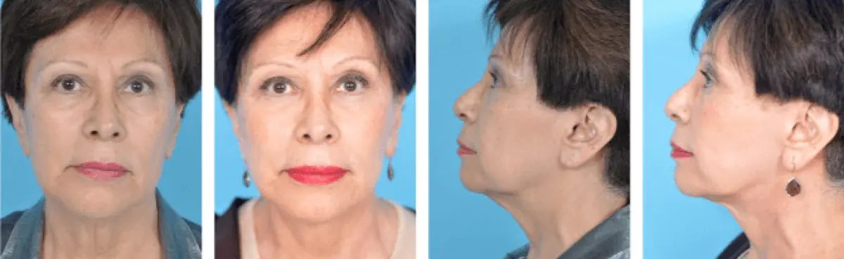 Plastic Surgery Chicago - Image 2