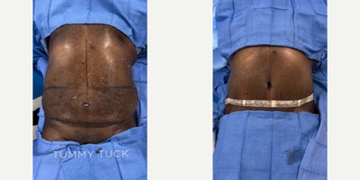 Case: 1 - before and after photo of Man in his mid 50s treated with Tummy Tuck by J. Timothy Katzen, MD, FACS