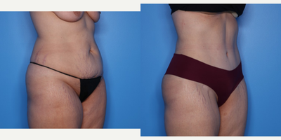 Case 1000 - 35-44 year old woman treated with Tummy Tuck