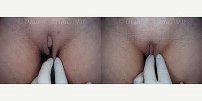 Case 10001 - 38 yo mother of three treated with Labia Majora Reduction and Vaginoplasty
