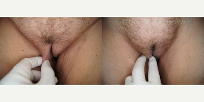 Case 10007 - 53 yo female treated with Labia Majora Reduction and Vaginoplasty (View 4 of 4)