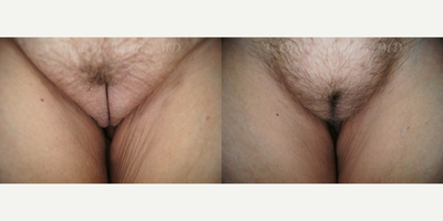 Case 10008 - 53 yo female treated with Labia Majora Reduction and Vaginoplasty (View 3 of 4)