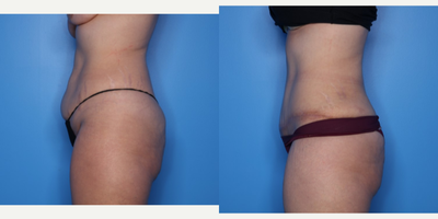 Case 1001 - 35-44 year old woman treated with Tummy Tuck