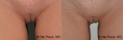 Case 10013 - Labia Majora Reduction 