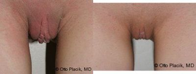 Case 10014 - Labia Majora Reduction