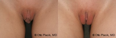 Case 10015 - Labia Majora Reduction 